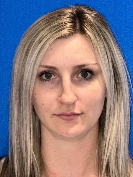 106281 Rhinoplasty c2 LF pre 1