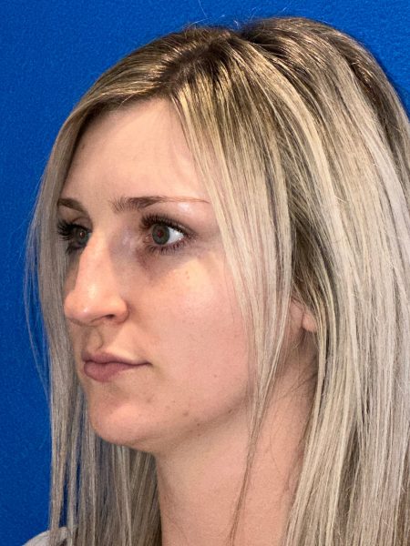 106281 Rhinoplasty c2 LF pre 2