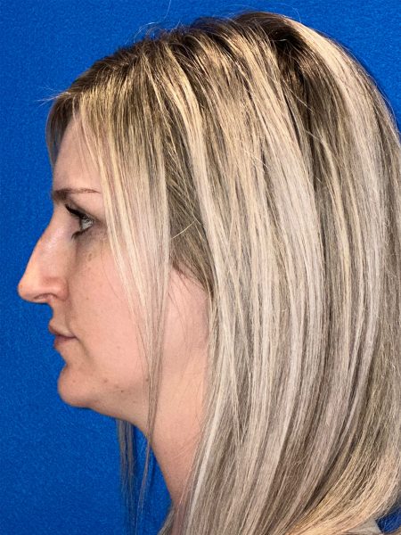 106281 Rhinoplasty c2 LF pre 3
