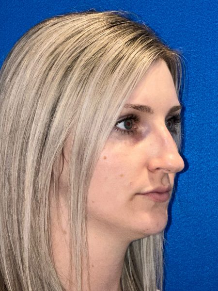 106281 Rhinoplasty c2 LF pre 4