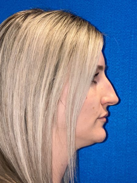106281 Rhinoplasty c2 LF pre 5