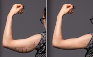 Before and after photos of woman who had arm lift to remove excess skin and bat wings