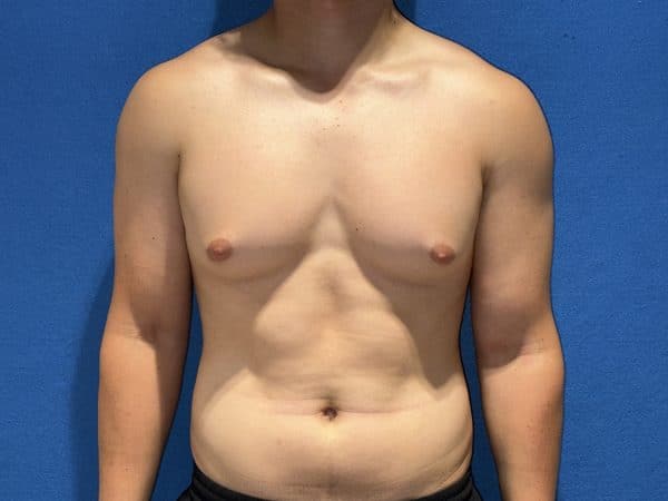 118774 Gynecomastia Pre 1 (1)