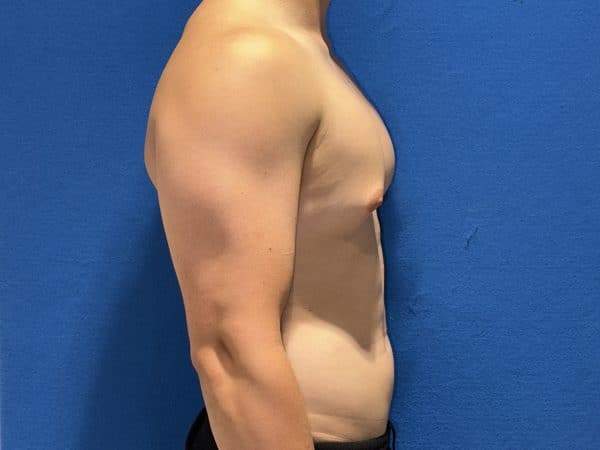 118774 Gynecomastia Pre 1 (2)