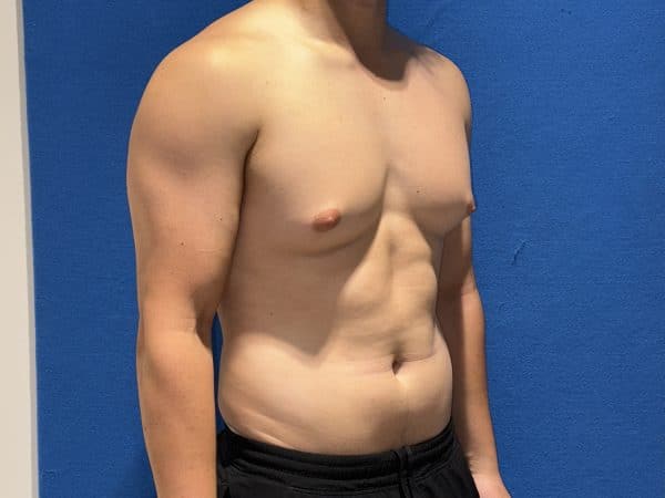 118774 Gynecomastia Pre 1 (3)