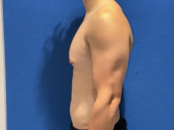 118774 Gynecomastia Pre 1 (4)
