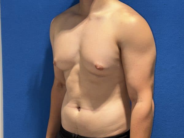 118774 Gynecomastia Pre 1 (5)