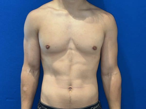 118774 Gynecomastia post 1 (1)