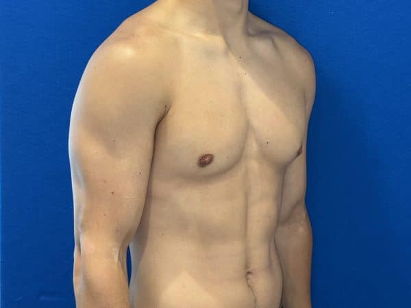 118774 Gynecomastia post 1 (10)
