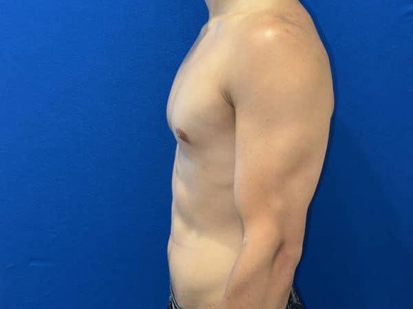 118774 Gynecomastia post 1 (7)
