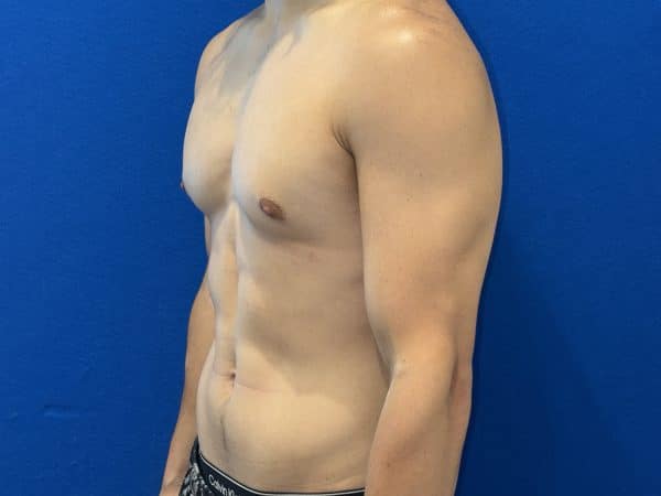 118774 Gynecomastia post 1 (8)