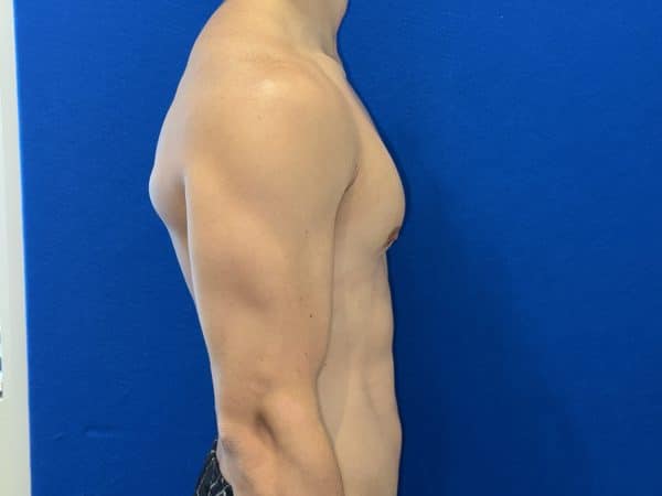 118774 Gynecomastia post 1 (9)
