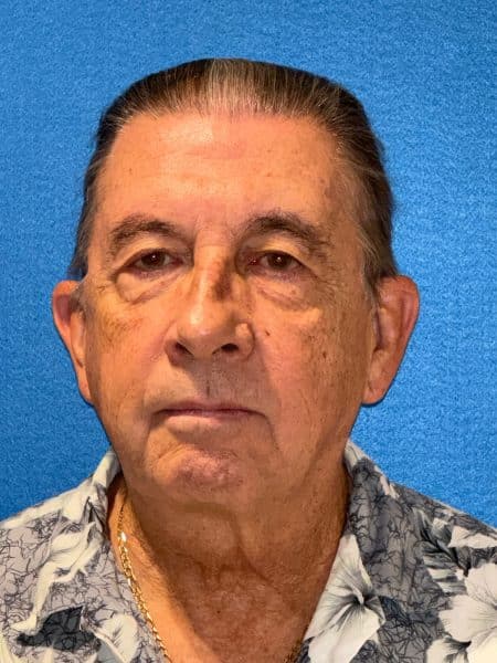 119619 Facelift DP Pre 1