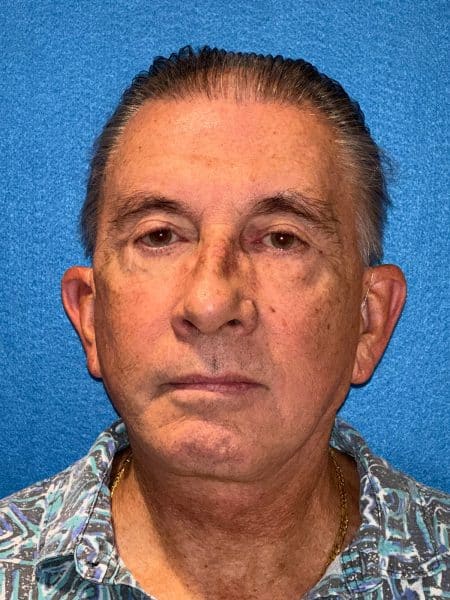 119619 Facelift DP post 1