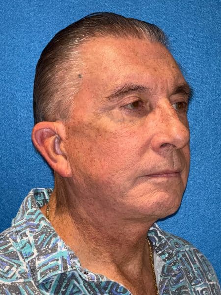 119619 Facelift DP post 2