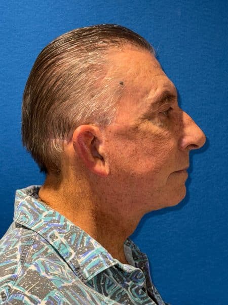 119619 Facelift DP post 3