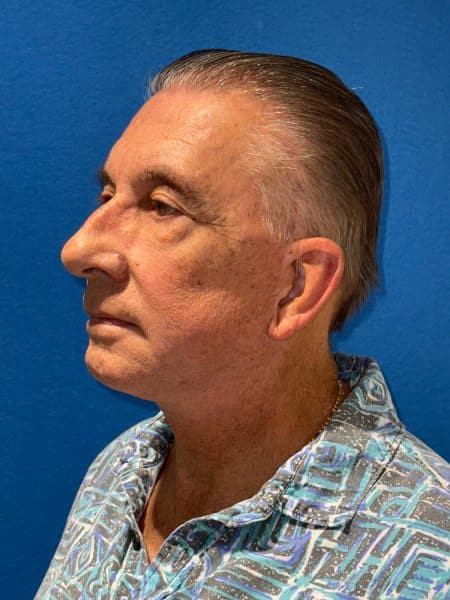 119619 Facelift DP post 4