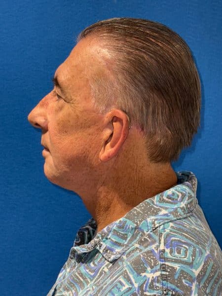 119619 Facelift DP post 5