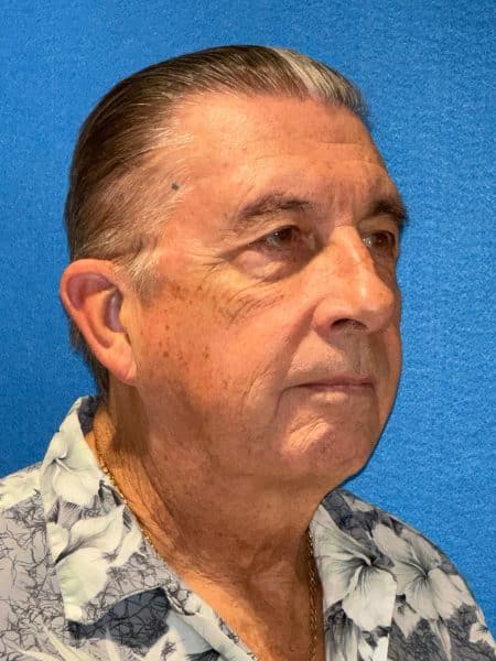 119619 Facelift DP pre 2