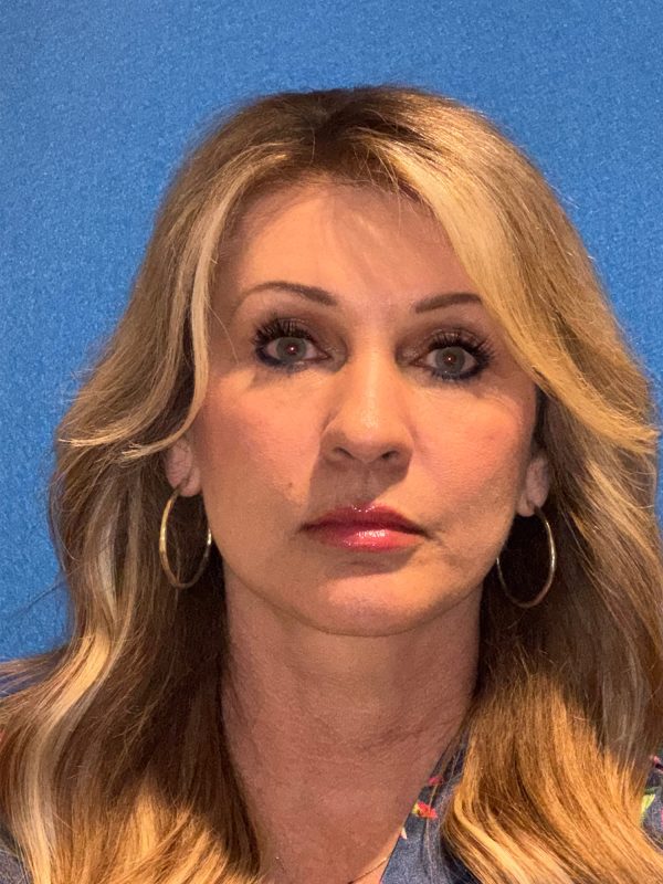 122987 facelift Post 1 (1)