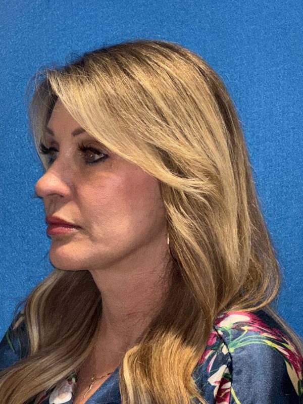 122987 facelift Post 1 (2)