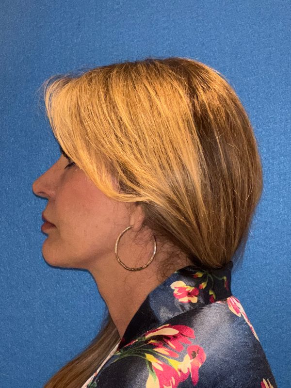 122987 facelift Post 1 (3)