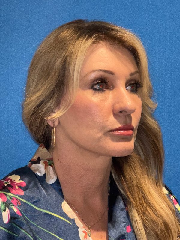 122987 facelift Post 1 (4)