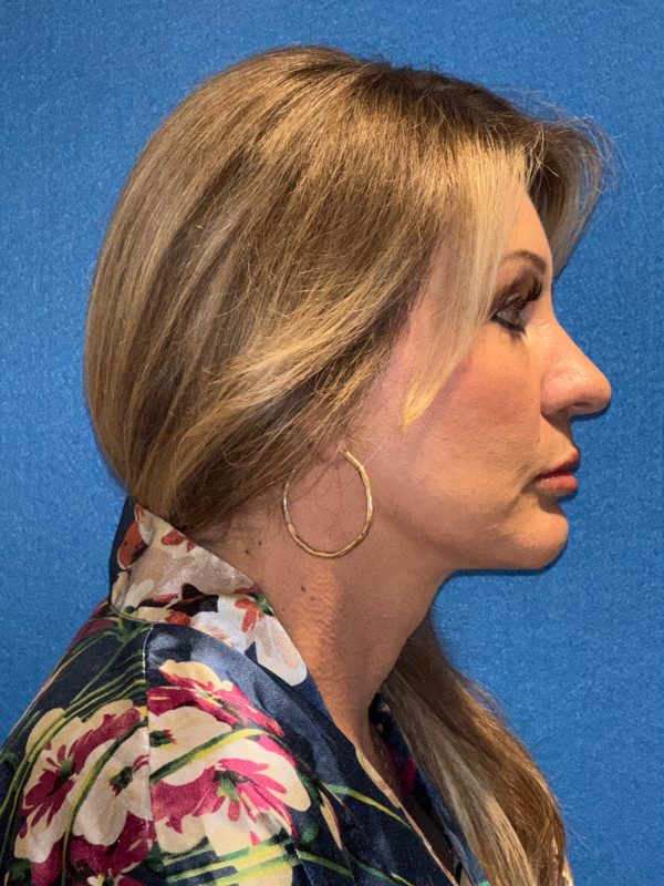 122987 facelift Post 1 (5)