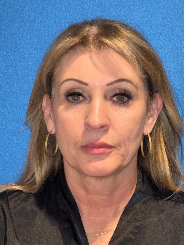 122987 facelift Pre 1 (1)