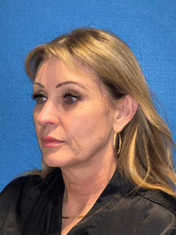 122987 facelift Pre 1 (2)