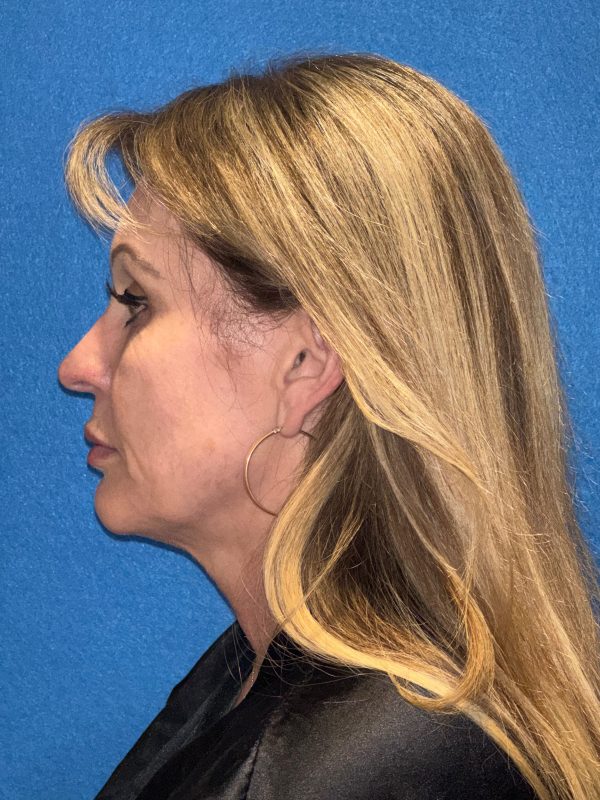 122987 facelift Pre 1 (3)