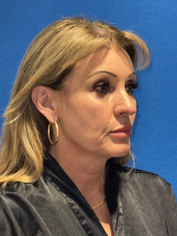 122987 facelift Pre 1 (4)