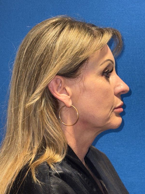 122987 facelift Pre 1 (5)