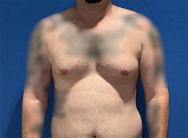 gynecomastia 1a