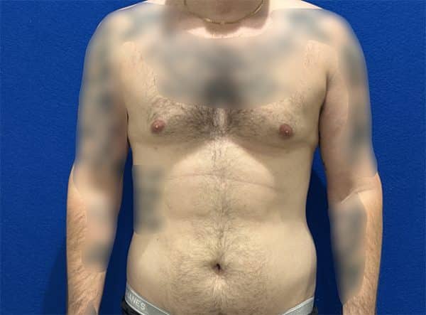 gynecomastia 1b