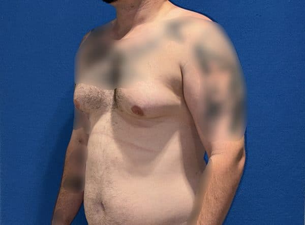gynecomastia 1c