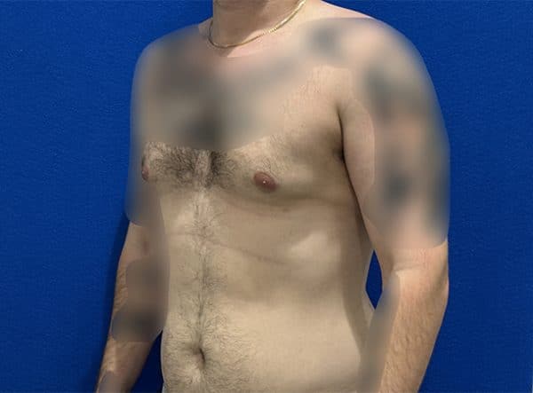 gynecomastia 1d 2