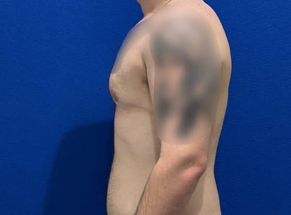 gynecomastia 1f