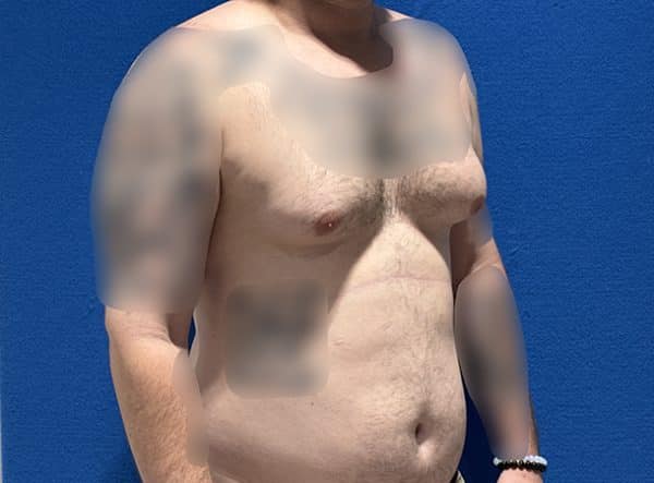 gynecomastia 1g