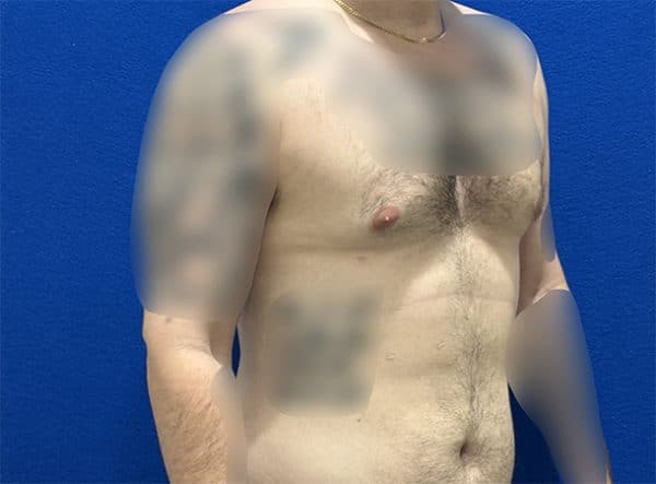 gynecomastia 1h