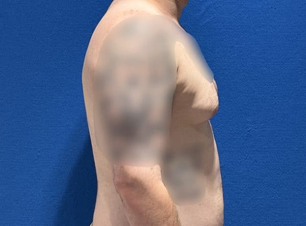 gynecomastia 1i