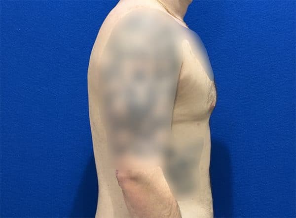 gynecomastia 1j